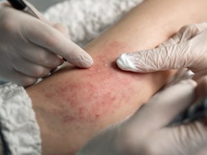 Tatouage flash : rougeur après 24h, soins recommandés